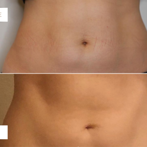 BYM - Before & After - body sculpting