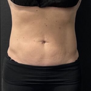 Coolsculpting After 2