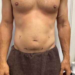 CoolSculpting Before 1