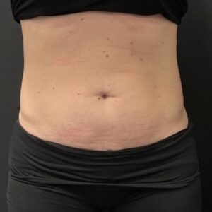 CoolSculpting Before 2