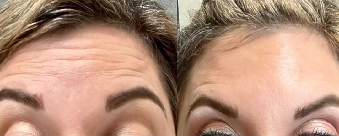What NOT To Do After Botox