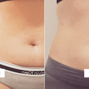 coolsculpting