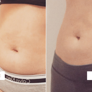 coolsculpting