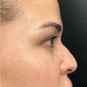 nurse sunmer nose filler (2)
